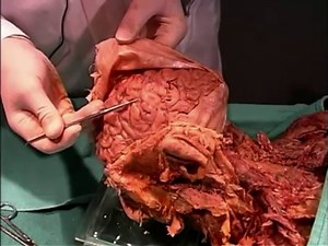 Human Anatomy Dissection 15 (part 1 of 2) Brain