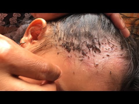 Removing Thousands Of Lice From Long Hair How To Remove It