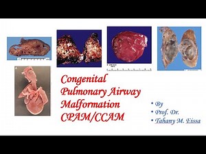 Congenital pulmonary airway malformation