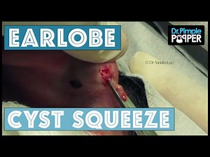 Squeezing Annoying Earlobe Cysts, bilaterally