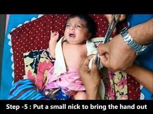 Vulpaeu sling application - Orthokids Clinic