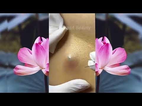 Big Blackhead ingrown hair removal.. Disgusting..