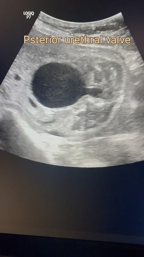 31 weeks pregnency with posterior urethral valve with hydronephrosis and oligohydroamnios #radiologist #ultrasoundmadeeasy | Ultrasound made easy