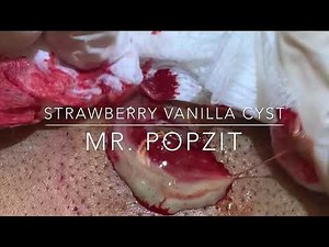 Strawberry Vanilla cyst-Full video
