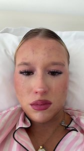 Reposting this cause I wanna change my caption I just wanna say acne is normal. I struggle with acne as you can see and if you struggle with acne, my page is a safe space what I just wanna add at the end of this is if you meet me in person, please do not bring up my acne that happened today and just as much as you guys can see it I can see it too and don’t need to be reminded thank you #samara