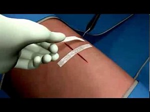 Como colocar la Sutura Adhesiva Steri-Strip!