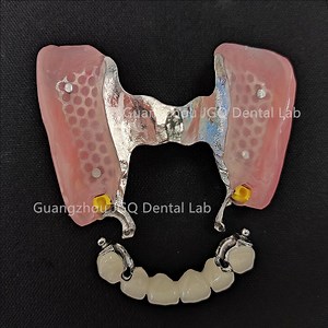 [Hot Item] Favorable Price Partial Precision Attachment Teeth Dental Dentures Framework for Full Mouth Removable Dentures