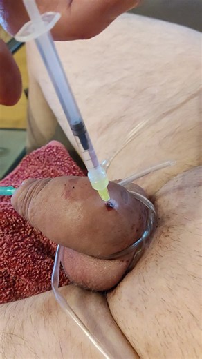 Saline and Needleplay - video 2