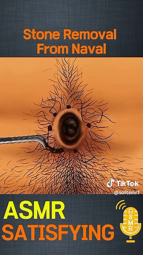 ASMR Stone Removal From Naval Treatment for Relaxation