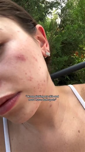 Golden boba for post-acne spots  Try Medicube Deep Vitamin C Golden Capsule Cream — now at @ikatehouse! Credit: @danicolexx ---⁠ Link In Bio(www.ikatehouse.com)⁠ #ikatehouse #onestopbeautyshop #onedollarbeautyshop #medicube #vitaminc #cream #acne #acnescars #glassskin #kbeautyproducts #skincareroutine #glowingskin #koreanskincare #beautyfinds #skincare #skincaretips #kbeauty | ikatehouse | Facebook