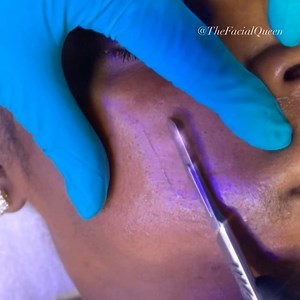 Satisfying oil-plane happening here 💦🔪🤩 Just like a dry Dermaplane, oil-planing gets rid of dead skin cells that could potentially cause congestion of the skin peach fuzz, which traps dirt and oil that could potentially lead to breakouts! Oil-planing is a more hydrating option, and I like using this technique on those with Dry/sensitive skin rosacea 🌹 | Sofia Skin Studio