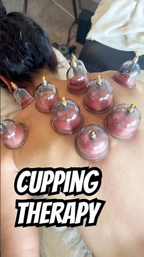 Cupping Therapy for Back Tension Relief