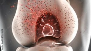 Animated Knee Pain and Osteoarthritis Explained Animated Illustration of Inflammation in the Knee Joint Joint Care and