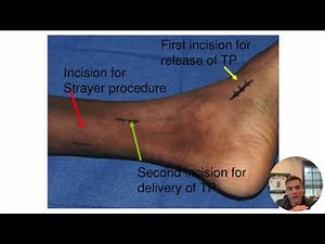 Tendon Transfers for Drop Foot -