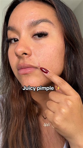 That moment when a pimple pops up at the WORST. TIME. EVER 🤬 Luckily our Acne Serum Spot Treatment dries it up ⚡️ fast! | UrbanSkinRx