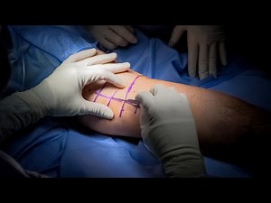 Posteromedial Technique for Management of Tricondylar Tibial Plateau Fractures