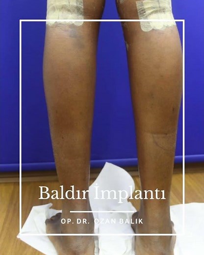 Calf Implant #calfımplant #calfaesthetic