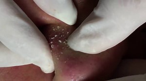 Pele com muita Acne - Limpeza de Pele Profunda - Clínica / Centro estética #15 [LATEST VIDEOS] #BlackheadRemove #PimplePopping #Acne | Pimple Popper