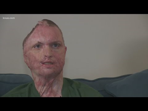 4th Degree Burns: Signs, Symptoms, & Treatment