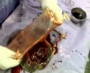 Placenta; Obs; detalhes no video A placenta é um órgão que só existe durante a gestação e tem diversas funções, como aconchegar o bebê dentro do útero, transferir nutrientes e oxigênio do sangue da mãe para o bebê e secretar alguns hormônios fundamentais para esta fase. Entretanto, durante a gravidez podem ocorrer alterações indesejadas da placenta, trazendo riscos e complicações para a mãe e o bebê. | Anatomia e Saúde