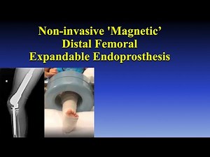Non invasive 'Magnetic' Distal Femoral Expandable Endoprosthesis