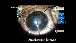 Membranous Cataract in a Child - Eyetube
