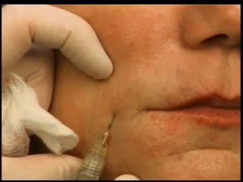 How to Lift Mouth Corners & Marionettes With A Dermal Filler