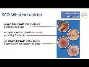 Skin Cancer: What it Is and How to Spot It.