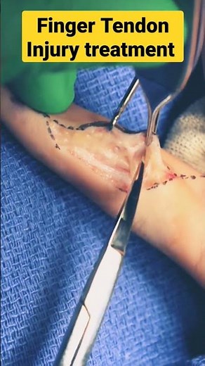 Finger Tendon Injury ✓✓✓