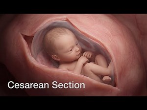 What Happens Inside the Body During a C-Section