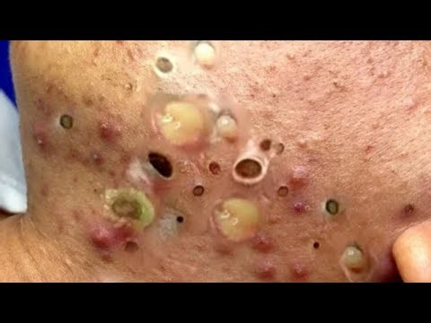 Full Acne Extraction Treatment | Calm & Relaxing ASMR Skincare #1000