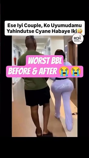 BBL( Brazilian Booty Lifting) BEFORE And AFTER Footage ( Rwandan Couple 🇷🇼🥰😭) #shorts #bbl