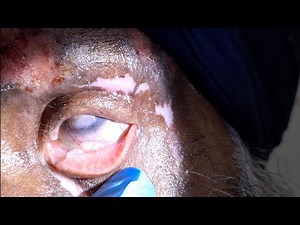 Dangerous case of HERPES ZOSTER OPHTHALMICUS