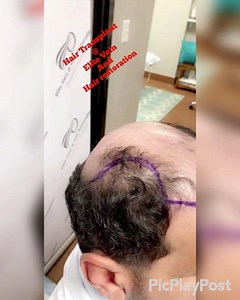 3950 Implanted Grafts 👏👏 THE ELITE FUE: HAIR-BY-HAIR TRANSPLANTATION Elite FUE (Follicular Unit Extraction) hair transplant is a proven, minimally invasive outpatient procedure in which follicular unit grafts, consisting of a small number of hair follicles, are individually removed from the genetically stronger areas of your scalp (the “donor” areas) and artistically restored to your thinning areas (the “recipient” areas). At Elite Vein and Hair Restoration we use the FUE natural graft placeme