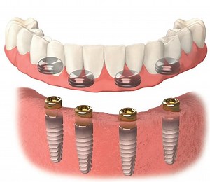 Snap-In Dental Implants | Snap-On Denture Implants