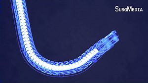 Flex® Robotic System: Expanding the reach of surgery | SurgMedia