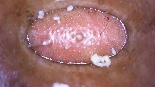 Effective Skincare: Pimple Removal Techniques