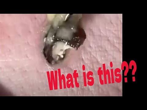 Cyst, Pimple & Zit Pops, explosions, squeezes and squirts!