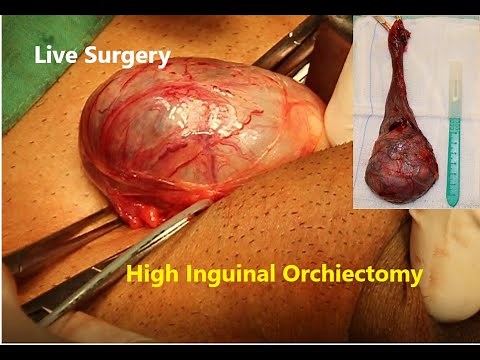 High Inguinal Orchiectomy for Testicular Cancer: Case Presentation and Live Surgery