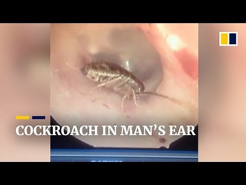 Cockroach in man’s ear