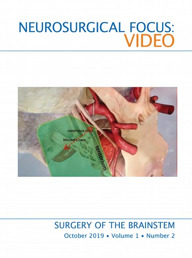 Telovelar approach for microsurgical resection of fourth ventricular subependymoma arising from rhomboid fossa: operative video and technical nuances