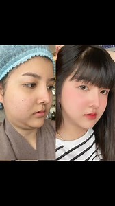 #liposuction #chinliposuction #submentalliposuction #faceliposuction #doublechin | Natchaya Clinic