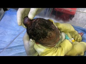 Newborn Baby with Encephalocele | Suction, Oxygen Support card clamp & NICU Initial Assessment