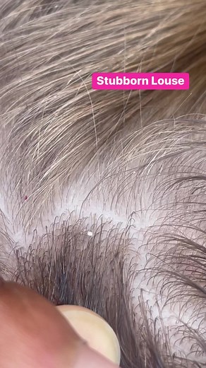 A baby Louse can be so small and hard to come off the hair.. they lay flat on the scalp, which make it hard to get them off #explore #lice #momlife #piojo #hair | Stacey The Louse Lady