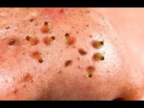 How To Removal Blackhead And How To Get Rid Of Blackhead Blackhead On Face #1