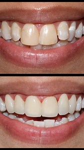 Transforming Smiles, One Veneer at a Time! Say goodbye to discolored, fluorosed, and misaligned teeth and hello to a perfectly aligned, naturally radiant smile! 😁💎 With 6 units of Porcelain Veneers, we restored confidence and beauty for this amazing smile! ✅ Stain-resistant ✅ Durable & Long-lasting ✅ Natural-looking & Custom-designed Your dream smile is just a consultation away! ✨ Book now at Dr. Kathuria’s Dentistry – where smiles get their perfect makeover! 🦷💙 📍 Dr. Kathuria’s Dentistry |