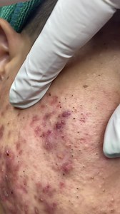 Pimple | Acne | Cravos | Espinhas | Satisfyng | Satisfyng Vídeos #satisfying #satisfyingvideo #pimple #cravos #espinhas