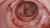 This 3d video shows the formation of diverticula in the colon