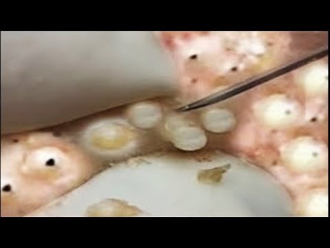 Deep blackhead extraction Cystic acne & pimple popping #23