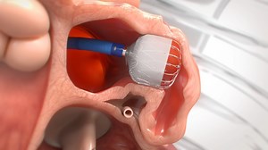 Implantable heart plug reduces threat of stroke in people with irregular heartbeats - WTOP News